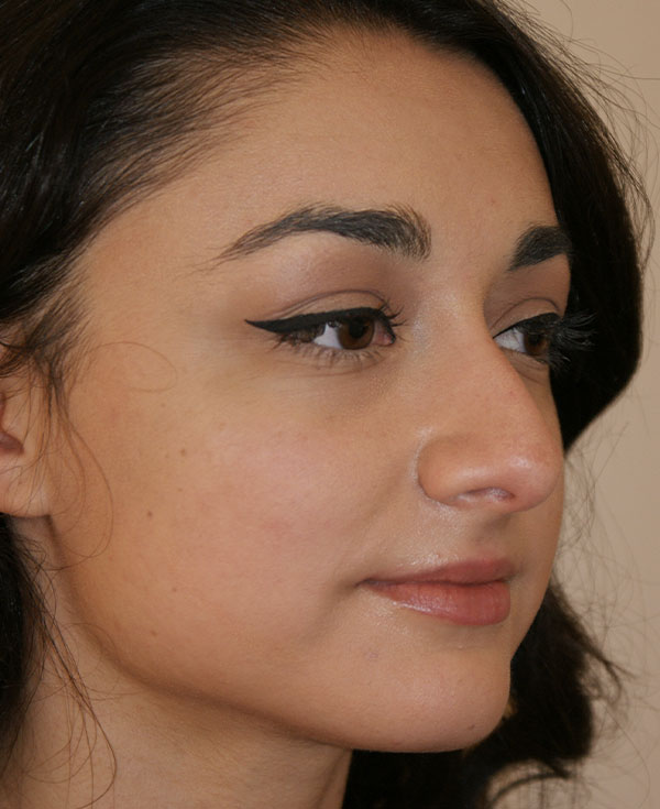 Photo of Patient 31 Before Nose Procedure