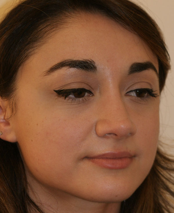 Photo of Patient 31 After Nose Procedure