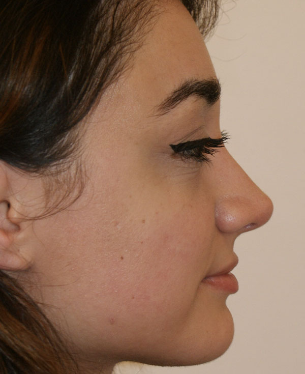 Photo of Patient 31 After Nose Procedure