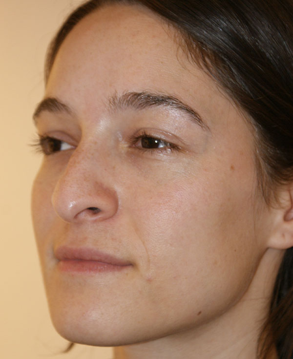 Photo of Patient 32 Before Nose Procedure