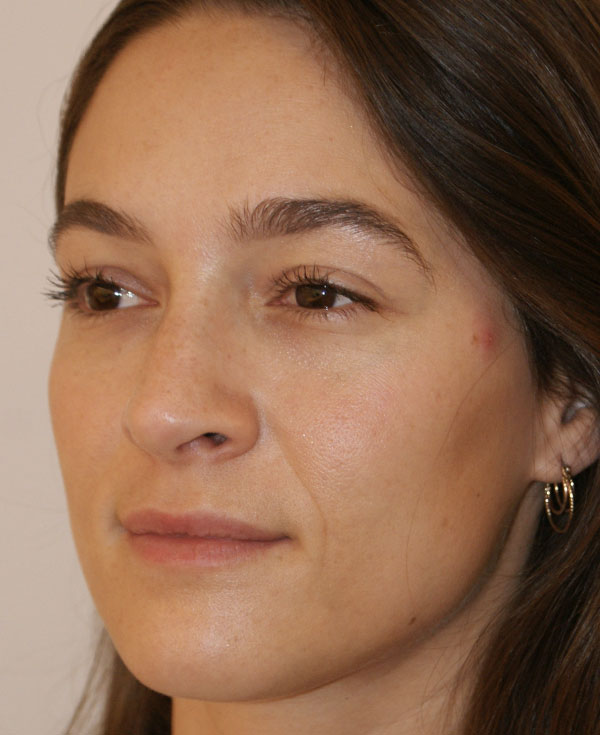 Photo of Patient 32 After Nose Procedure