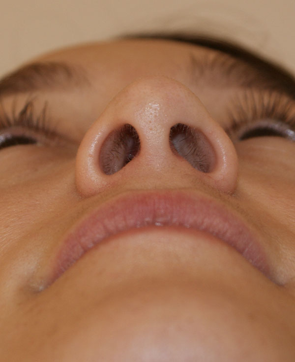 Photo of Patient 32 After Nose Procedure