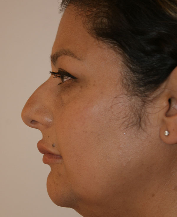 Photo of Patient 33 Before Nose Procedure
