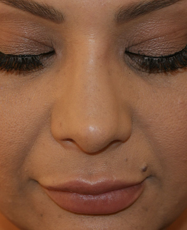 Photo of Patient 33 After Nose Procedure