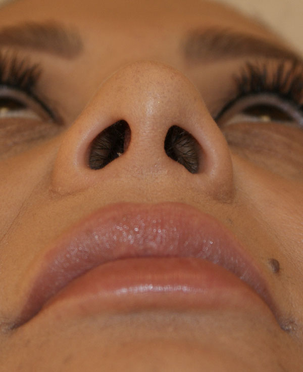 Photo of Patient 33 After Nose Procedure