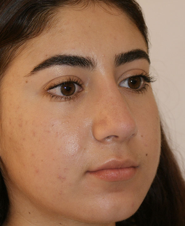 Nose Before and After | Dino Elyassnia, MD