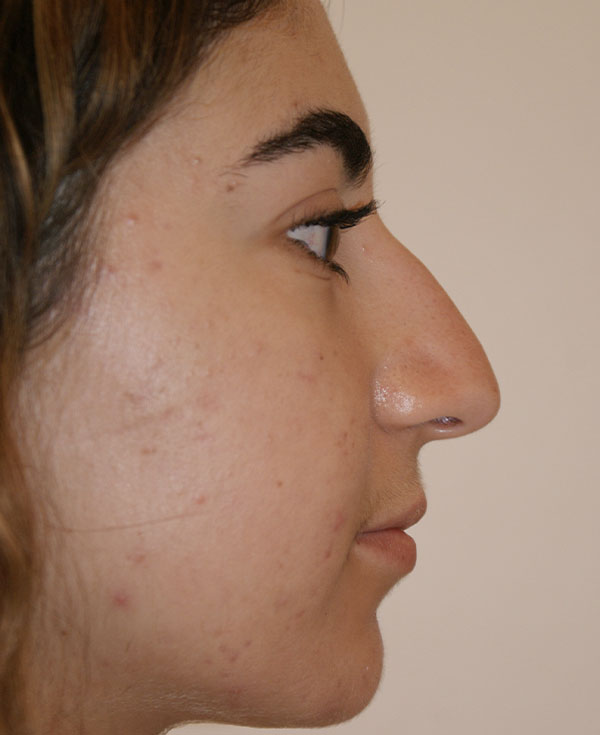 Photo of Patient 34 Before Nose Procedure