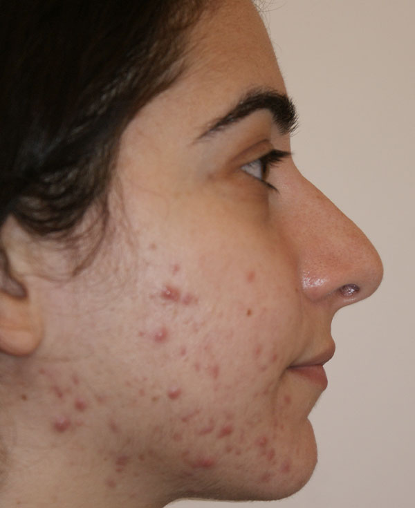 Photo of Patient 35 Before Nose Procedure