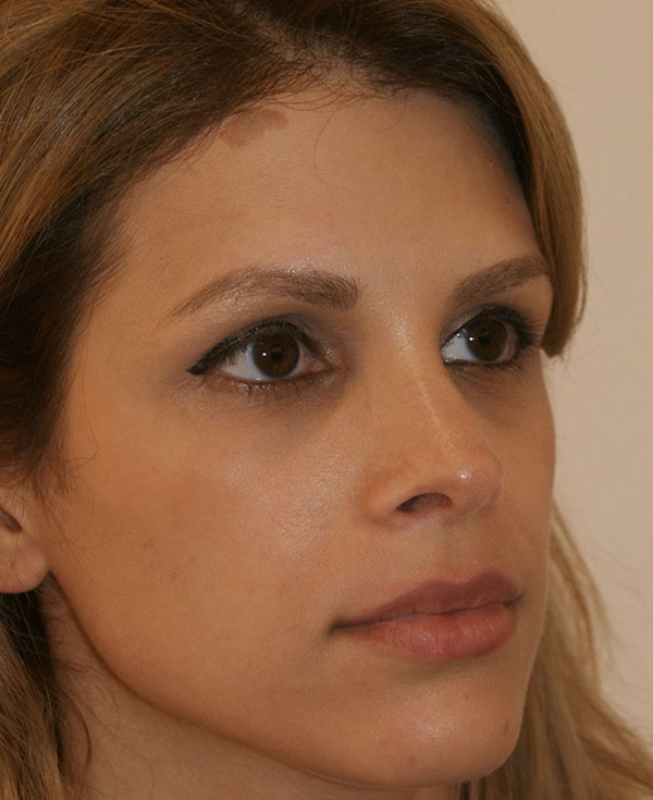 Photo of Patient 36 After Nose Procedure