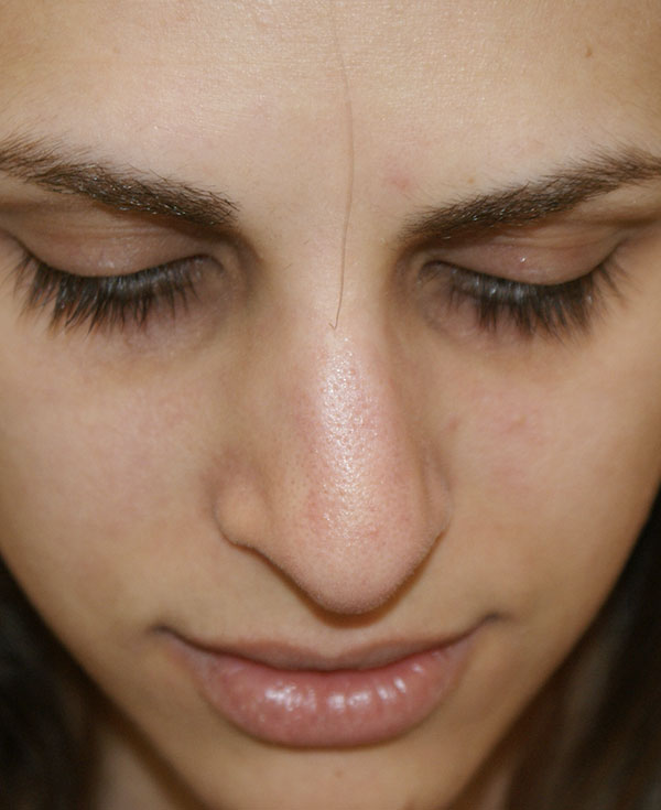 Photo of Patient 36 Before Nose Procedure