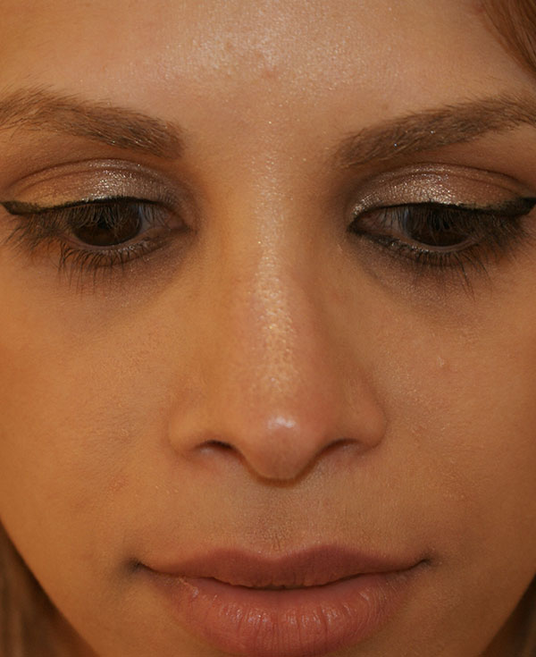 Photo of Patient 36 After Nose Procedure