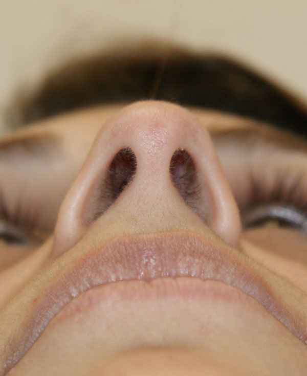 Photo of Patient 36 Before Nose Procedure