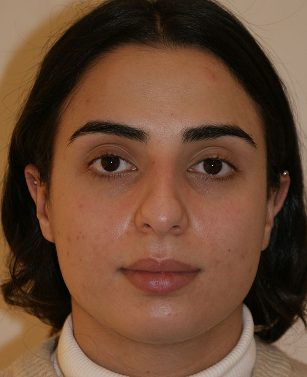 Nose Before and After | Dino Elyassnia, MD