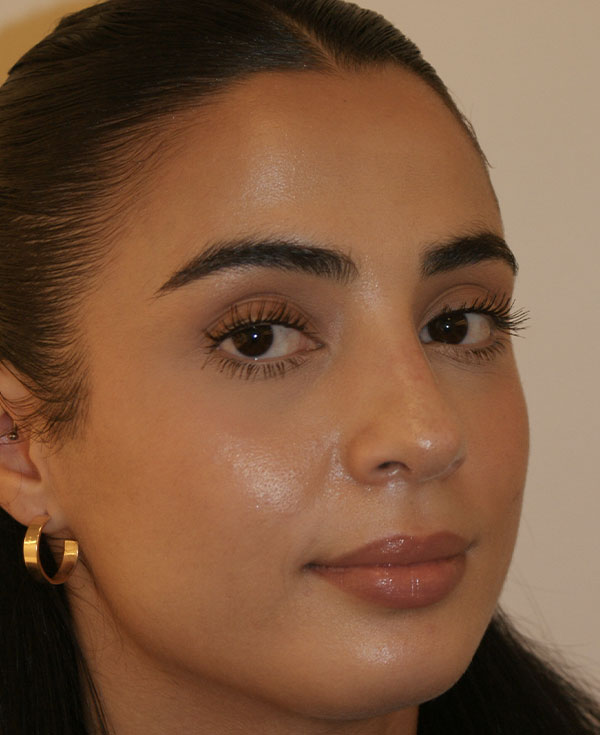 Photo of Patient 37 After Nose Procedure