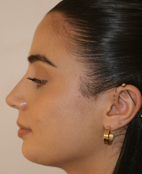 Photo of Patient 37 After Nose Procedure