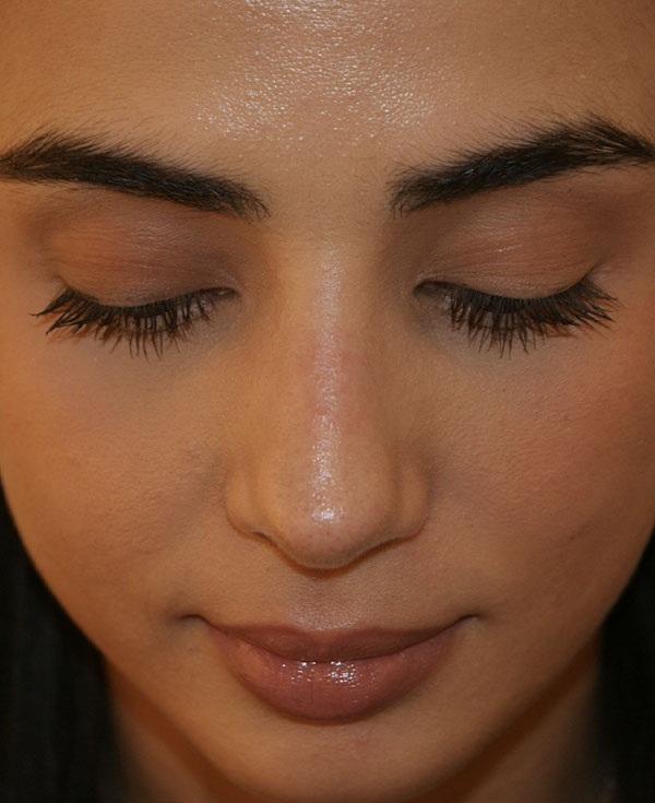 Photo of Patient 37 After Nose Procedure