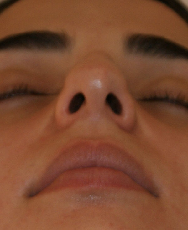 Photo of Patient 37 Before Nose Procedure