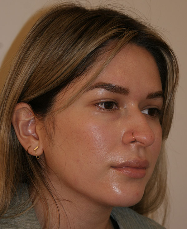 Photo of Patient 38 Before Nose Procedure