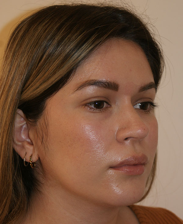 Photo of Patient 38 After Nose Procedure