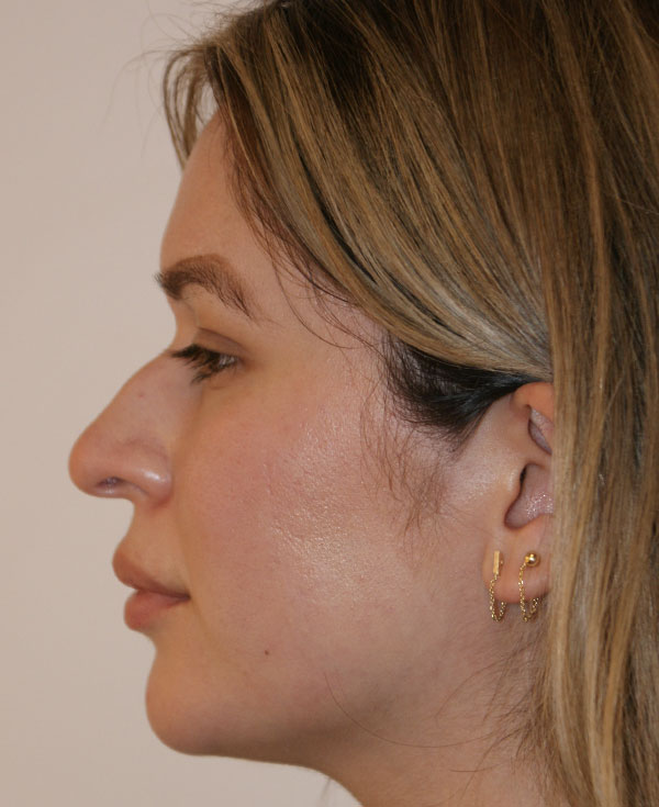 Photo of Patient 38 After Nose Procedure