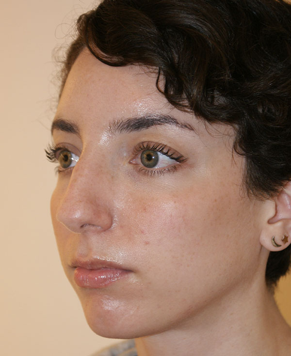 Photo of Patient 39 Before Nose Procedure