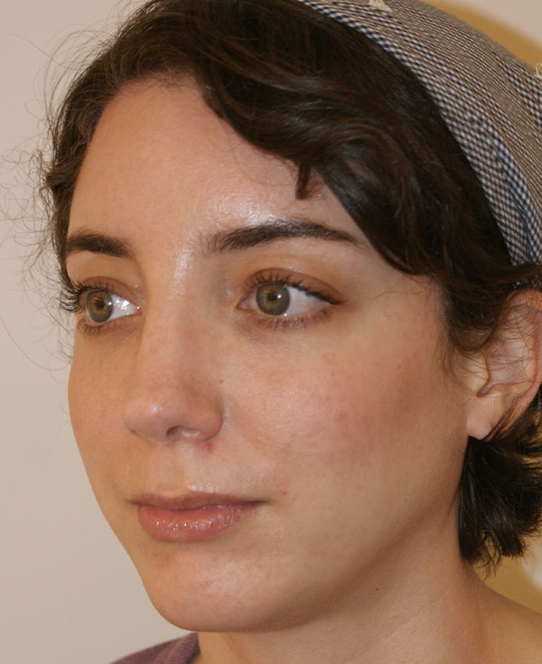 Photo of Patient 39 After Nose Procedure