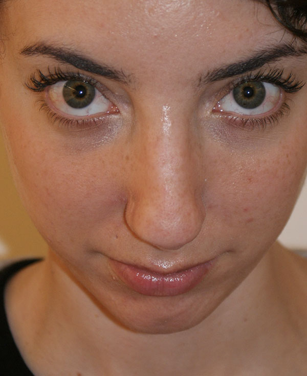 Photo of Patient 39 Before Nose Procedure