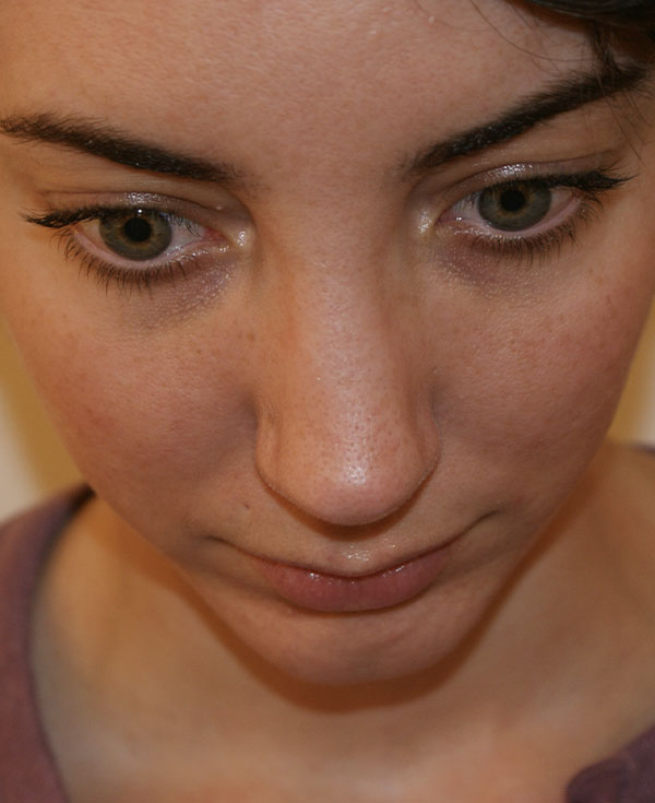 Photo of Patient 39 After Nose Procedure