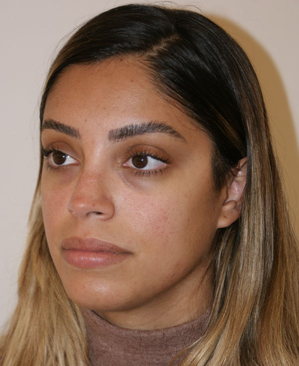 Photo of Patient 40 After Nose Procedure