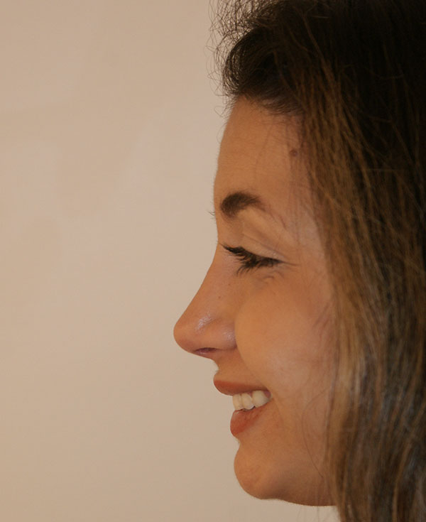 Photo of Patient 41 After Nose Procedure