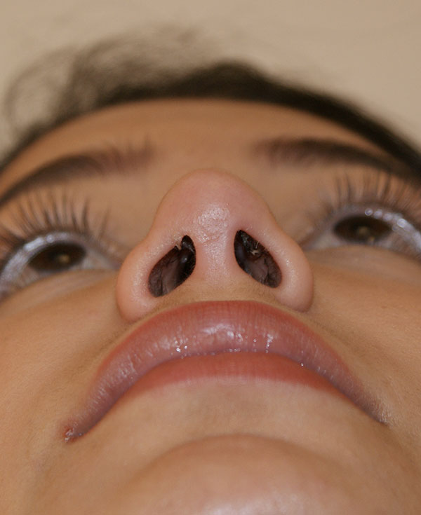 Photo of Patient 41 After Nose Procedure