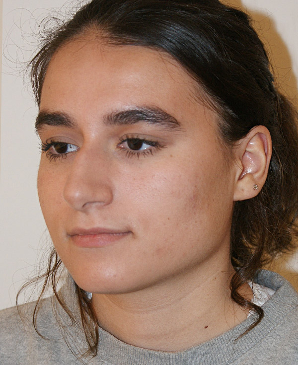 Photo of Patient 42 Before Nose Procedure