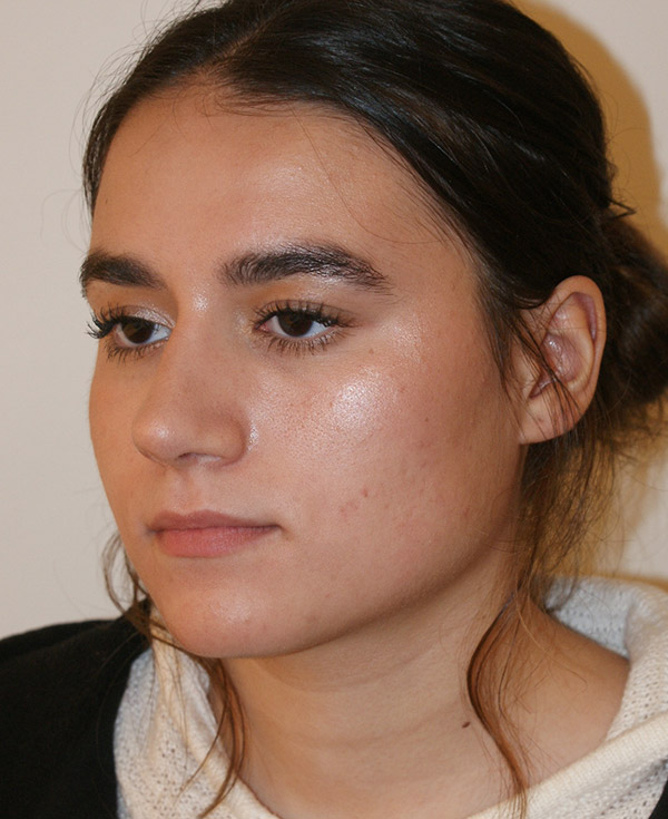Photo of Patient 42 After Nose Procedure