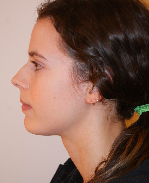 Photo of Patient 43 Before Nose Procedure