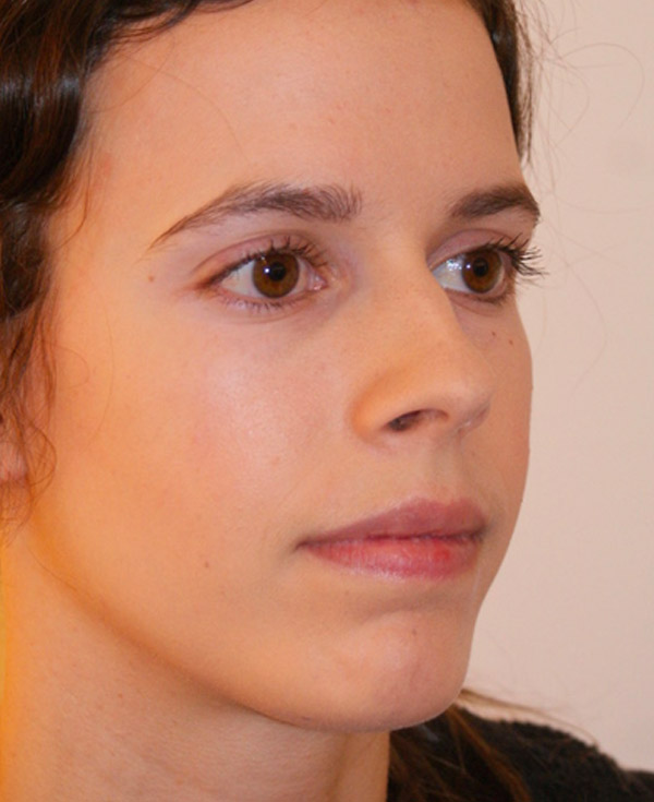 Photo of Patient 43 Before Nose Procedure