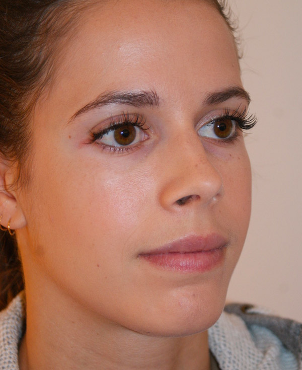 Photo of Patient 43 After Nose Procedure