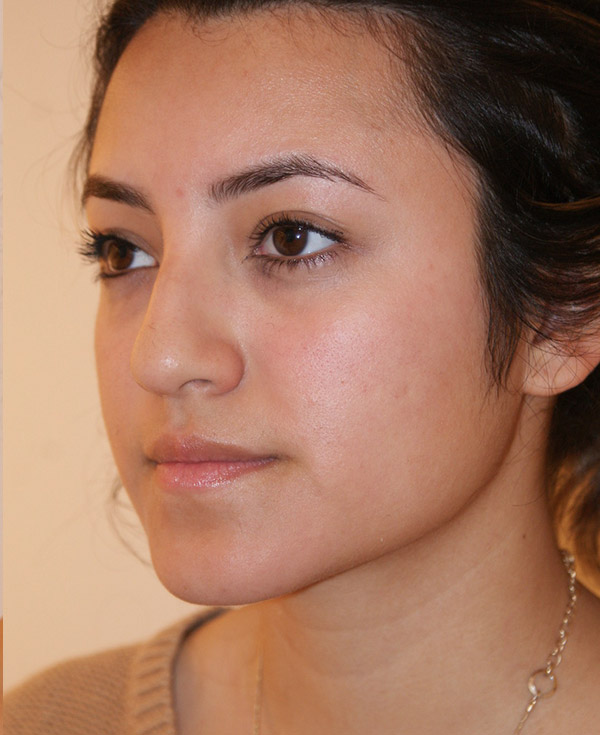 Photo of Patient 44 Before Nose Procedure