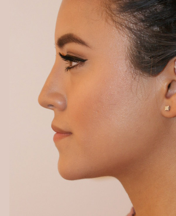 Photo of Patient 44 After Nose Procedure