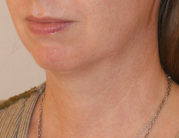 Short Scar Neck Lift Before and After | Dino Elyassnia, MD