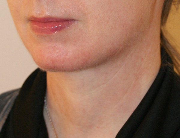 Short Scar Neck Lift Gallery Patient 1