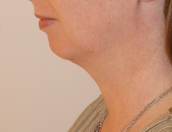 Photo of Patient 01 Before Short Scar Neck Lift Procedure