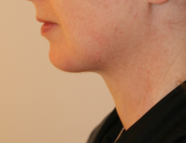 Photo of Patient 01 After Short Scar Neck Lift Procedure