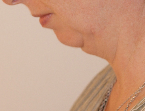 Photo of Patient 01 Before Short Scar Neck Lift Procedure