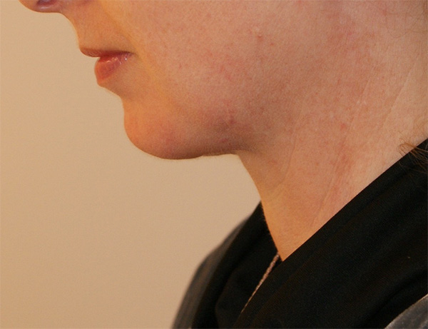 Photo of Patient 01 After Short Scar Neck Lift Procedure