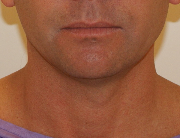 Photo of Patient 02 Before Short Scar Neck Lift Procedure