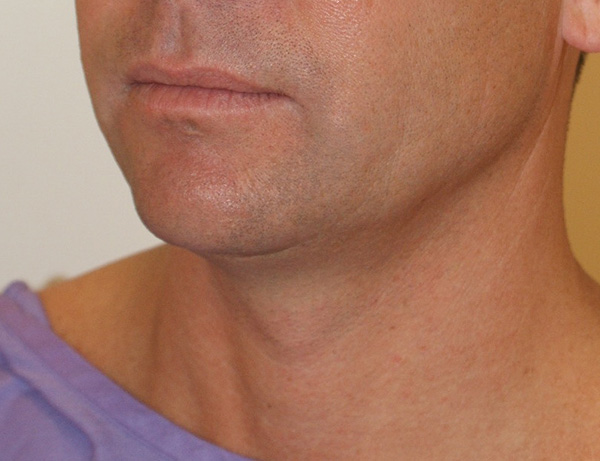 Photo of Patient 02 Before Short Scar Neck Lift Procedure