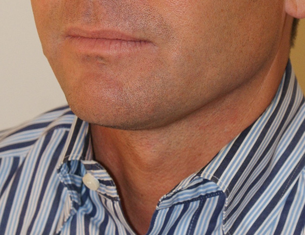 Photo of Patient 02 After Short Scar Neck Lift Procedure