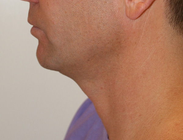 Photo of Patient 02 Before Short Scar Neck Lift Procedure