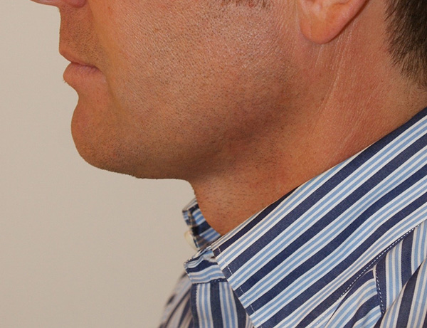 Photo of Patient 02 After Short Scar Neck Lift Procedure