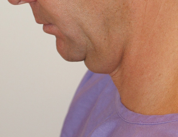 Photo of Patient 02 Before Short Scar Neck Lift Procedure